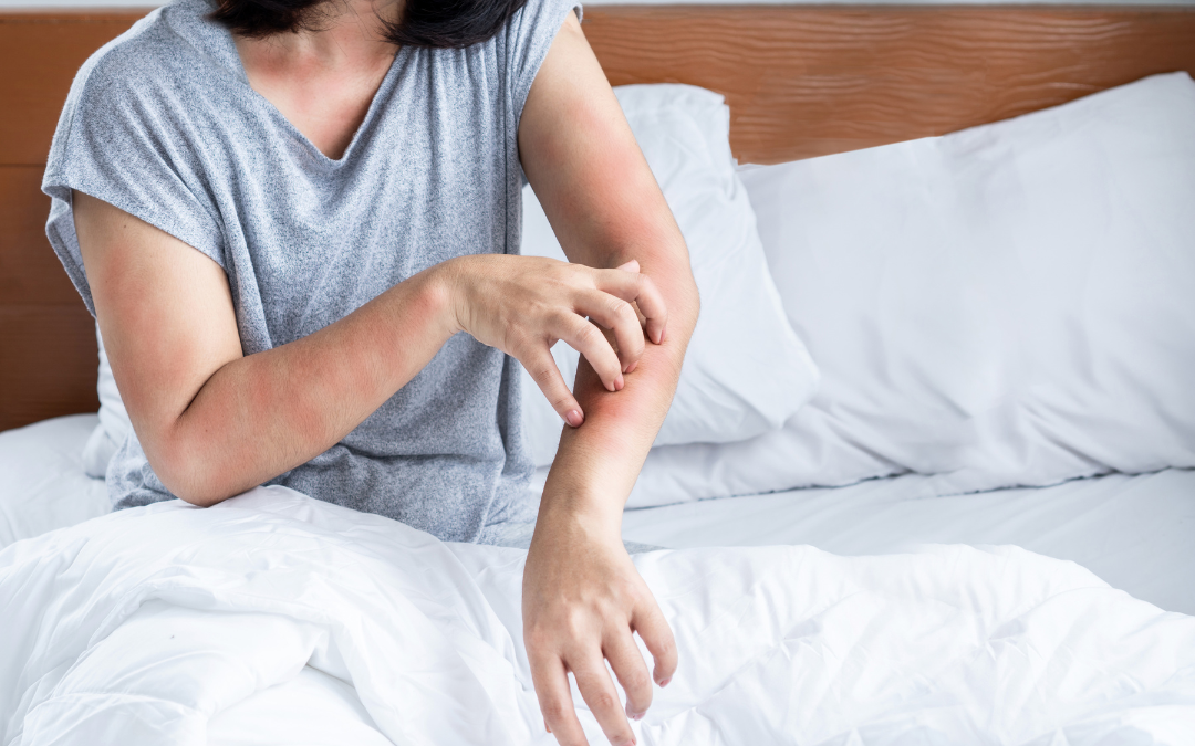 What is atopic dermatitis and how does it affect your sleep?